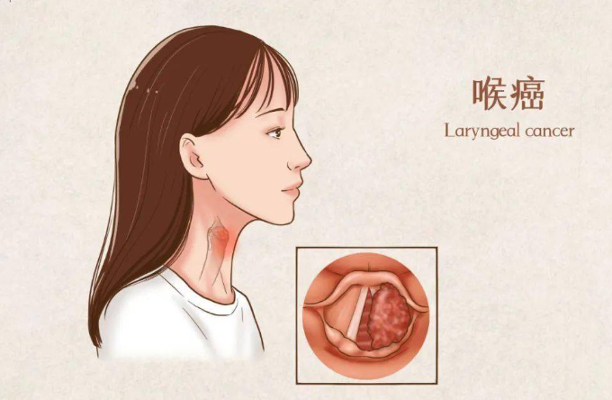 喉癌